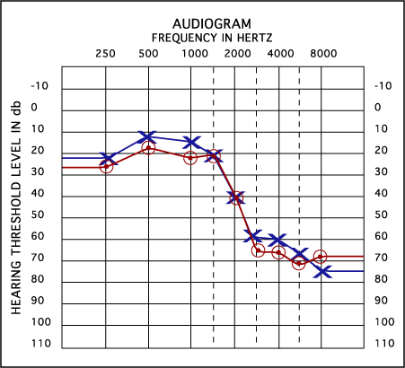 Hearing Test Frequency Chart